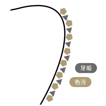齒面附著因飲食習慣所積累的色素與常年污垢。